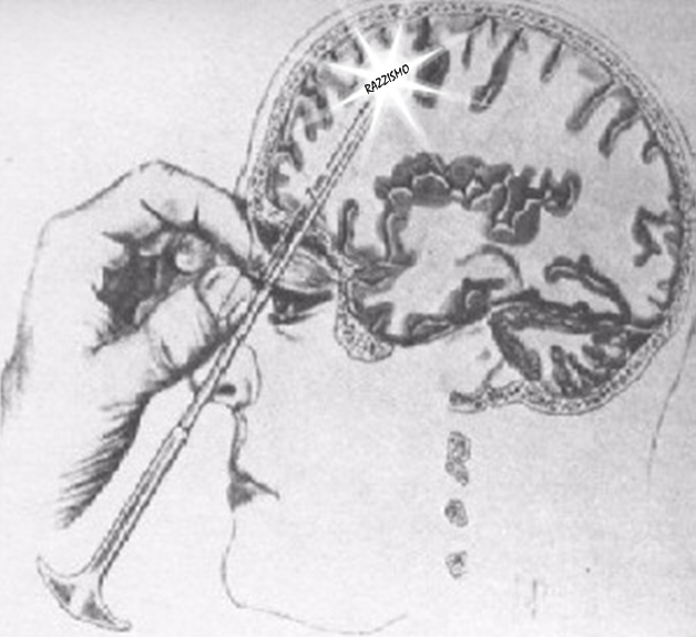 lobotomy
